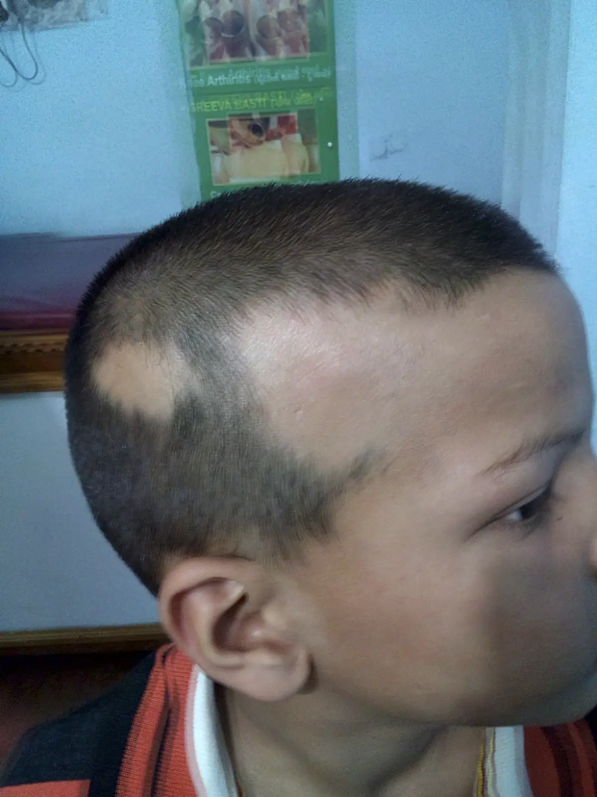 Alopecia Areata case 6 before treatment